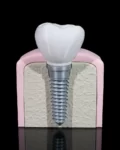 Mokomasis modelis Implantas