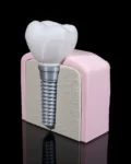 Mokomasis modelis Implantas